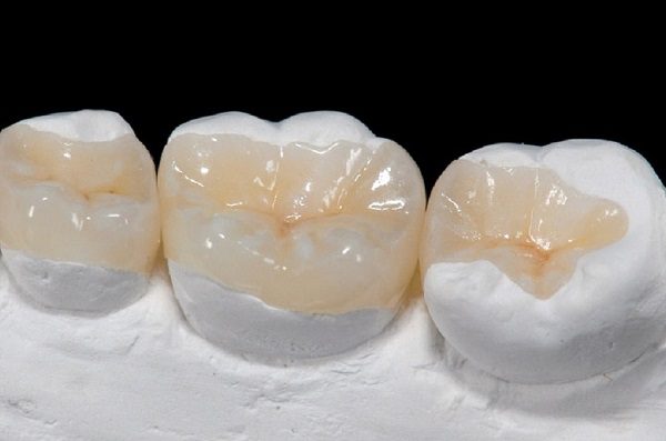 اینله و آنله روش های ترمیمی غیر مستقیم