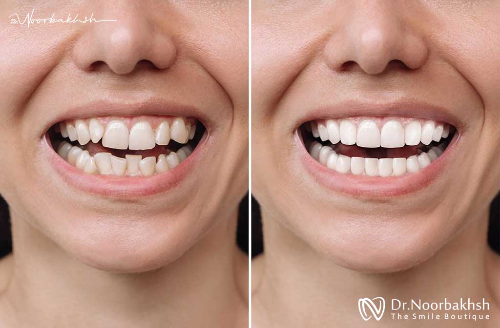 لمینت برای دندان های کج