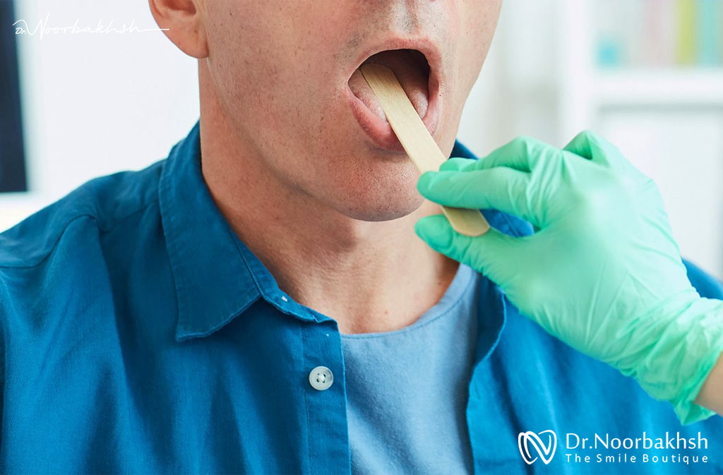 زگیل تناسلی HPV دهانی