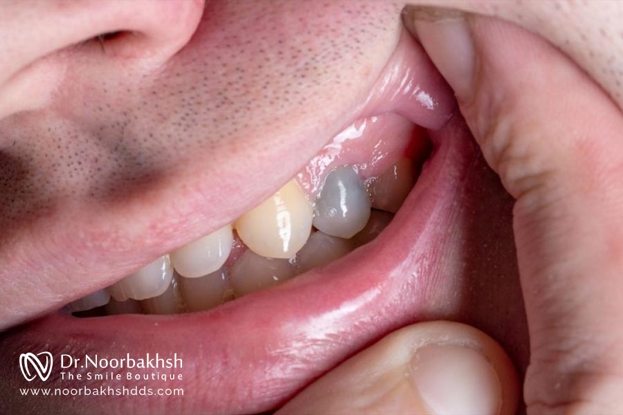 عوارض بلندمدت عصب کشی