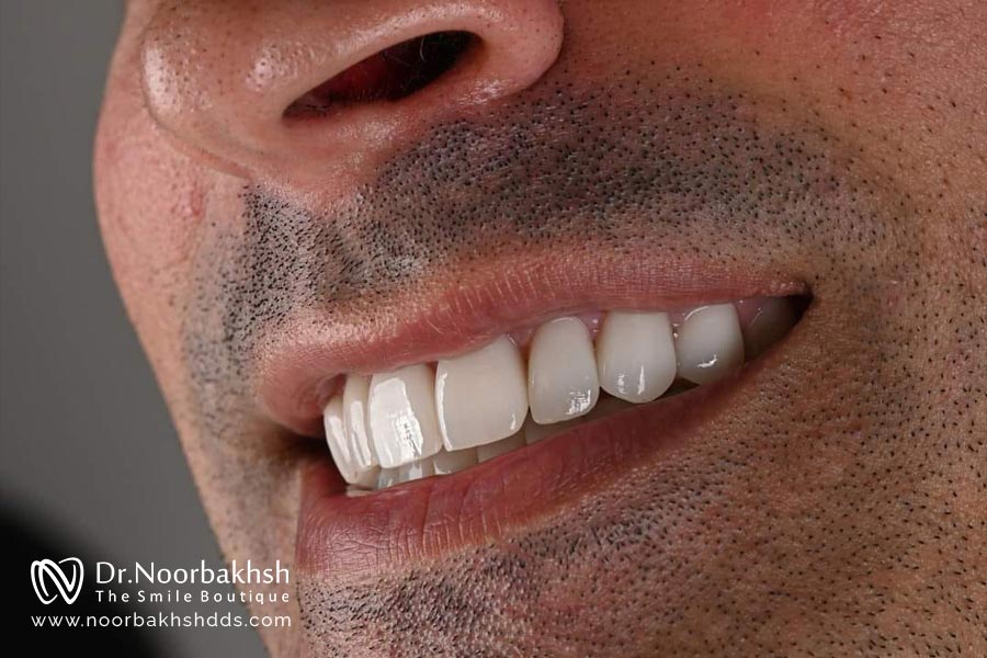 کامپوزیت دندان مردانه