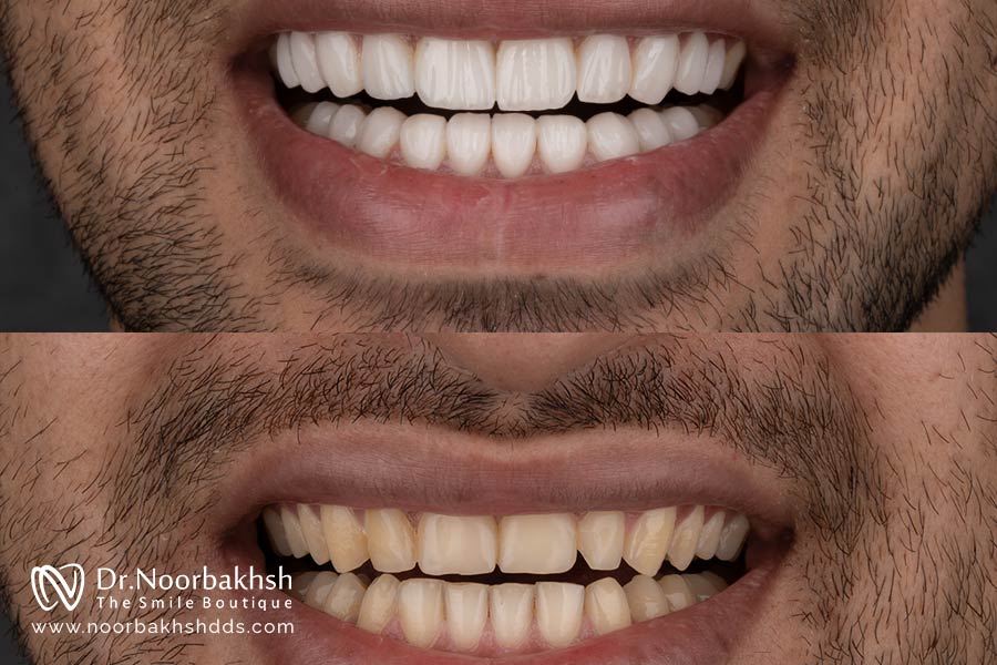 نمونه کار عکس قبل و بعد کامپوزیت دندان مردانه