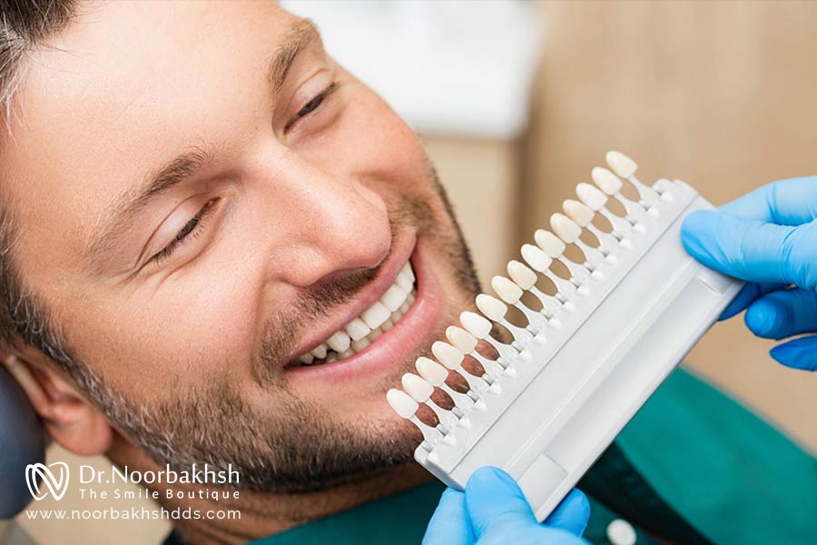 مزایای کامپوزیت دندان برای آقایان چیست؟